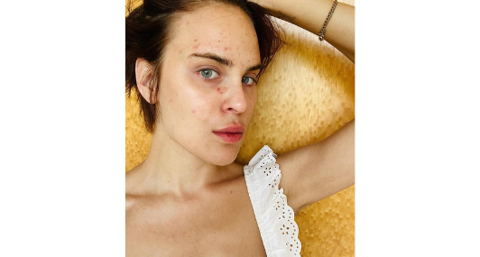 Here's One Secret Even Vogue Doesn't Know About Skin-Picking Disorder
