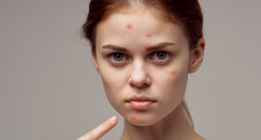 The Aftermath of Skin Picking (guest blog)