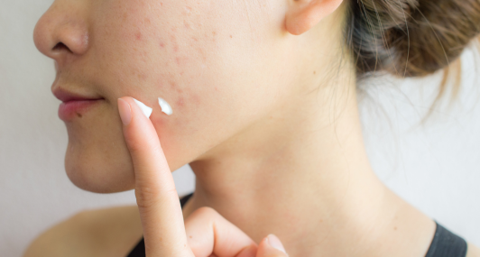 Never Use This Popular DIY Pimple "Hack".